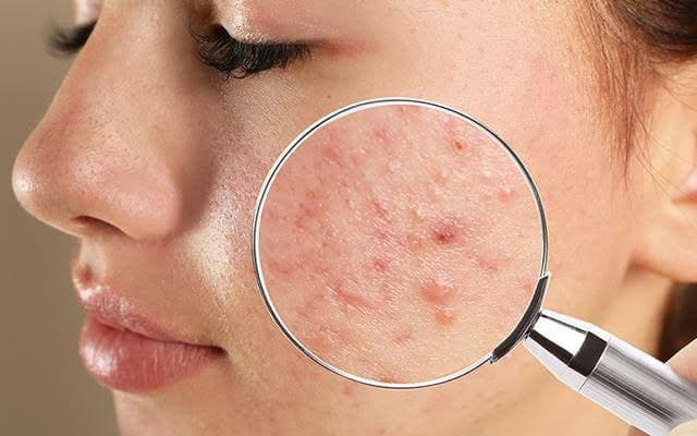pimples removal tips hindi